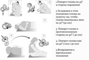 Способы избавления от головокружения