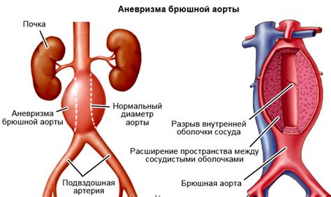 Способы самодиагностики наличия расширения брюшной аорты