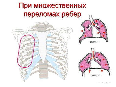 Способы снятия неприятных ощущений в области ребер слева