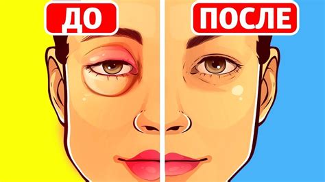 Способы снять отек глаза
