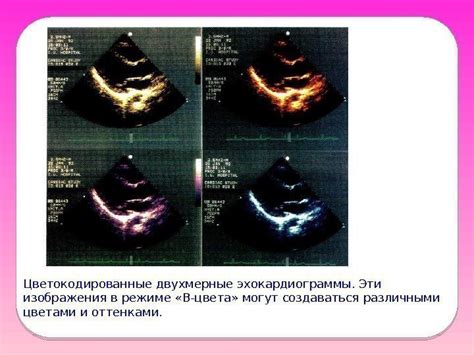 Сравнение данных эхокардиограммы и латеральных эхосигналов в диагностике сердечных заболеваний
