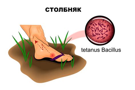 Столбняк: заболевание, требующее пристального внимания