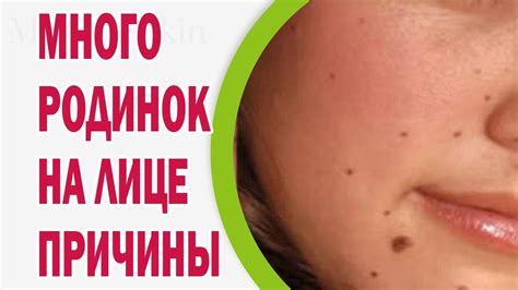 Структура родинок и их склонность к кровотечениям