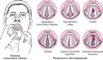 Травмы голосовых связок