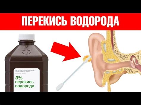 Улучшение комфорта ушей с помощью перекиси водорода