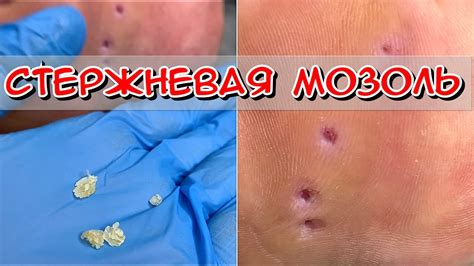 Устранение воздушных пузырей: первоочередное удаление иглой или аналогичным предметом