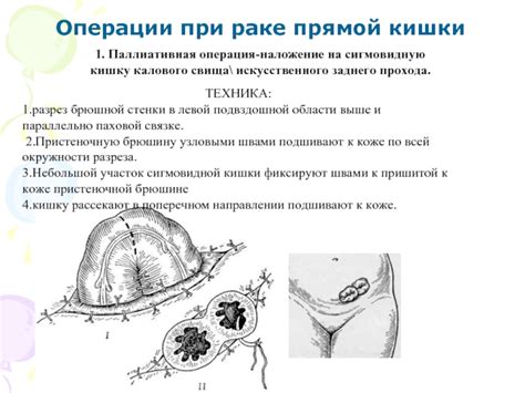 Участие левой паховой области в родовом процессе