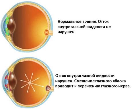 Факторы риска развития глаукомы