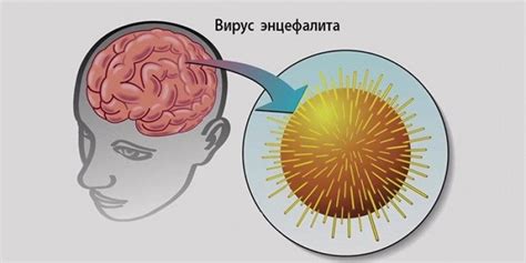 Физические проявления энцефалита у человека