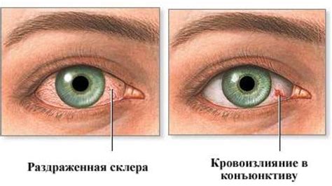 Что делать, если лопнула вена в глазу