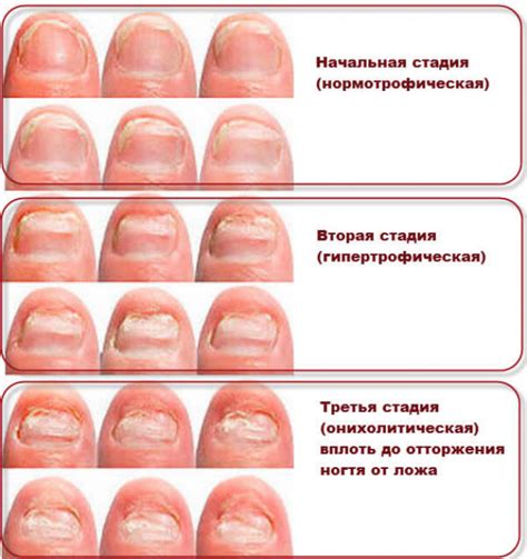 Что необходимо знать о грибковых поражениях ногтей: факты и заблуждения