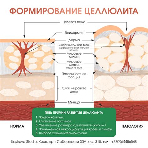 Что скрывается за ягодицами: причины образования целлюлита на этой части тела