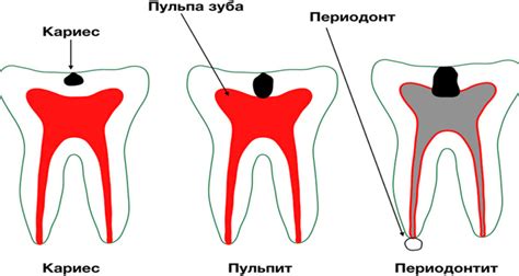 Что такое Глюфокам
