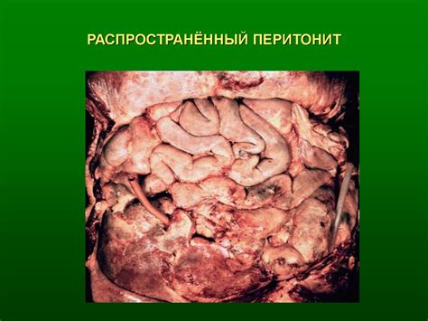 Что такое гнойный децидуит