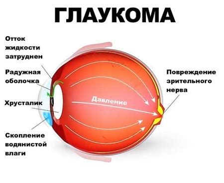 Что такое повышенное глазное давление