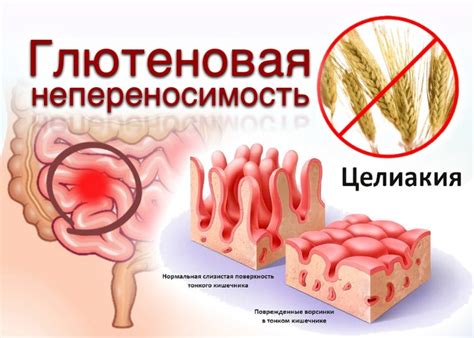 Что такое целиакия: симптомы и диагностика