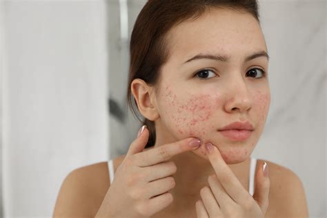 Эффективные методы лечения глубоких подкожных прыщей