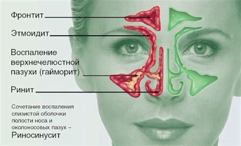 Эффективные рекомендации для облегчения состояния при аллергическом отеке носовой полости