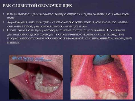  Важность своевременного выявления новообразований на дне рта 