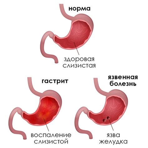  Гастрит и язва желудка: основные причины кровотечения при рвоте 