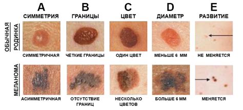  Генетические факторы, влияющие на появление пигментных невусов 