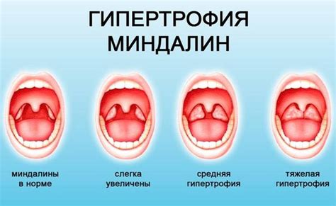  Гланды: как определить, стоит ли удалять 