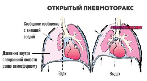  Дыхательная недостаточность: причины и последствия 