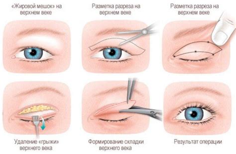  Консервативное воздействие на отечность покровов над верхними глазами 