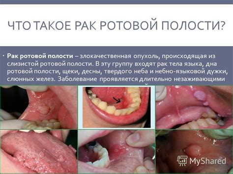 Покраснение и опухоль десны 