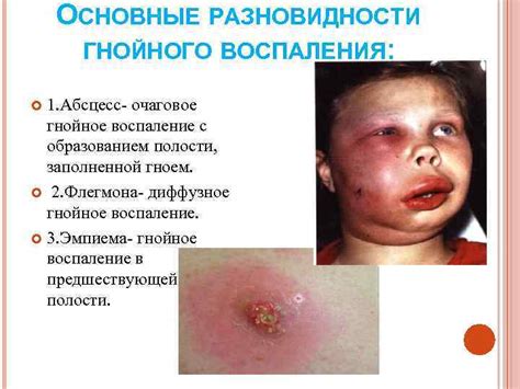  Симптомы гнойного воспаления 