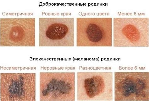  Что делать, если родинка была сильно повреждена 