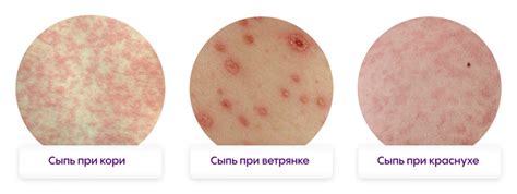 22. Симптомы, указывающие на наличие сыпи у малыша