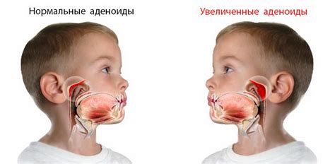 Аденоиды и тонзиллы