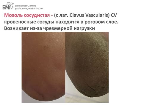 Альтернативные методы удаления мозолей
