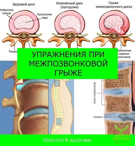 Альтернативы операции при позвоночной грыже