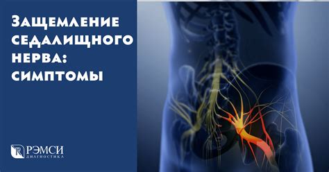 Анатомия седалищного нерва и его воспаление