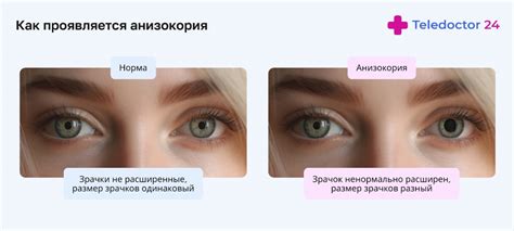 Анизокория: причины и рекомендации