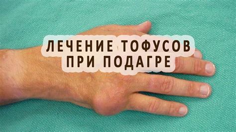 Аргументы в пользу удаления тофусов при подагре