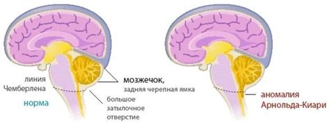 Арнольд-Киари: методы лечения и профилактика