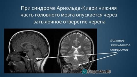 Арнольд-Киари: причины возникновения