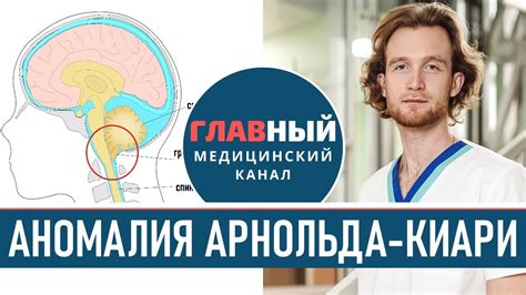 Арнольд-Киари: симптомы и диагностика