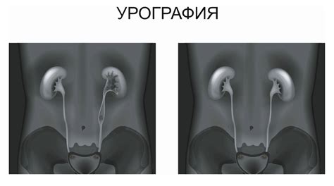 Болезни почек и КТ с контрастным веществом