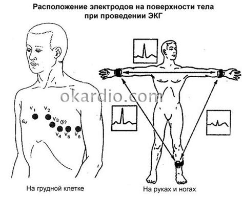 Болезнь исходов проведения ЭКГ