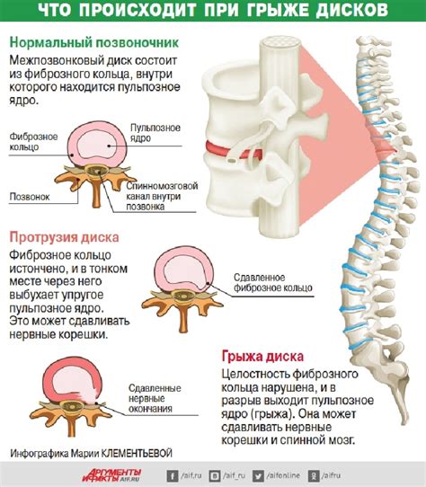 Боли в пояснице и грыжа: связь и особенности