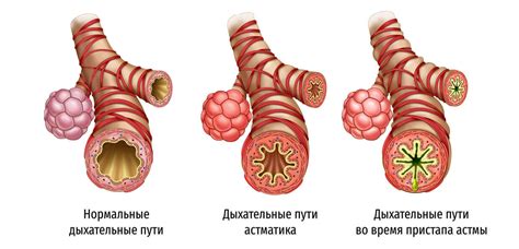 Бронхиальная астма