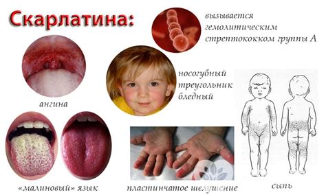 Важность прививки от скарлатины для детей