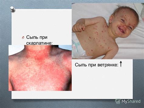 Важные моменты по гулянию при скарлатине