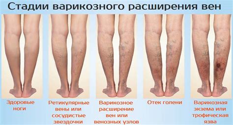 Варикозное расширение вен