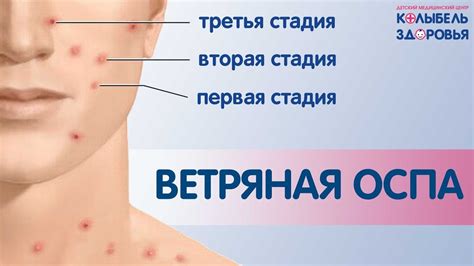 Ветрянка у взрослых: частое явление