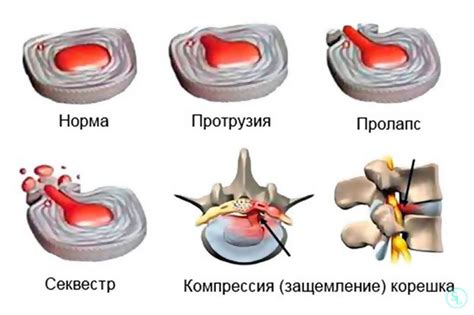 Влияние бега на грыжу позвоночника
